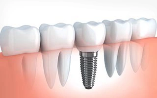 Dental Inplants